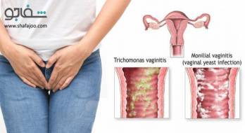 واژینیت تریکومونایی (تریکومونیاز) - vaginitis trichomonal واژینیت تریکومونایی (تریکومونیاز) - vaginitis trichomonal