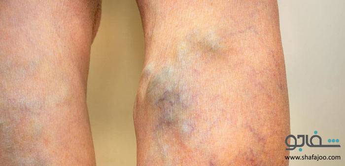 ترومبوز ورید عمقی - thrombosis deep vein