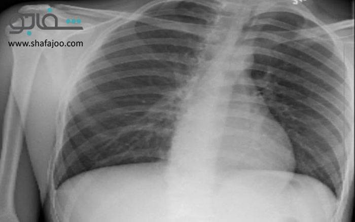 پنوموتوراکس - pneumothorax