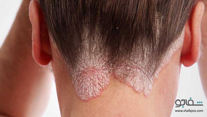 پسوریازیس - psoriasis