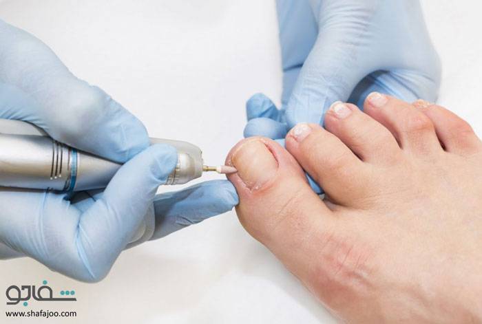 فرو رفتن ناخن پا در گوشت - toenail ingrown