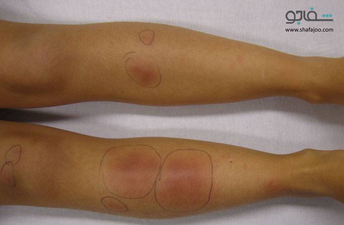 اریتم گرهی - Erytheerythema nodosum.
