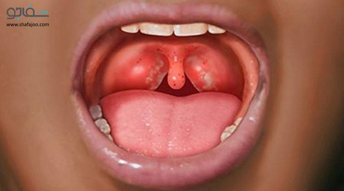 گلودرد استرپتوکوکی - strep throat